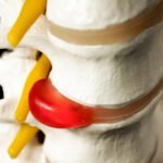 Hernia discal