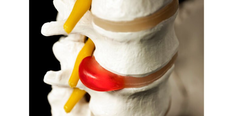Hernia discal Hernia discal