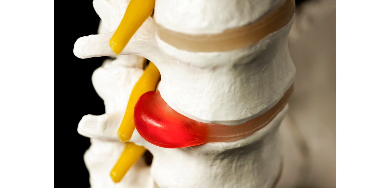 Hernia discal