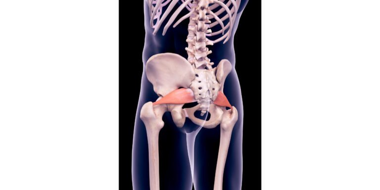 Síndrome piriforme o piramidal Síndrome piriforme o piramidal